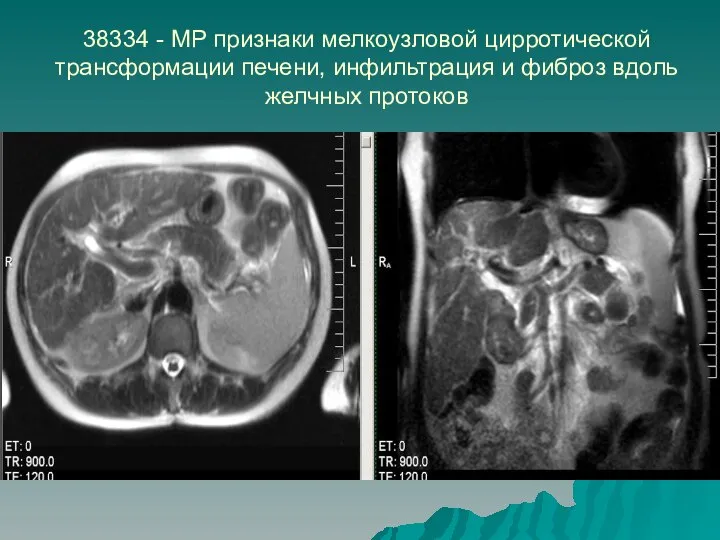 38334 - МР признаки мелкоузловой цирротической трансформации печени, инфильтрация и фиброз вдоль желчных протоков