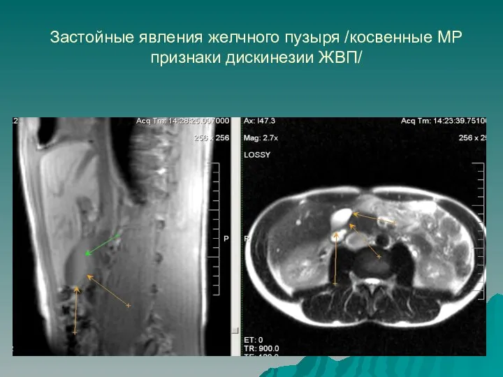 Застойные явления желчного пузыря /косвенные МР признаки дискинезии ЖВП/