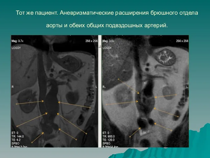 Тот же пациент. Аневризматические расширения брюшного отдела аорты и обеих общих подвздошных артерий.