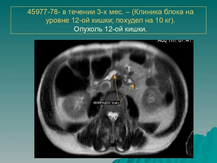 45977-78- в течении 3-х мес. – (Клиника блока на уровне 12-ой кишки;