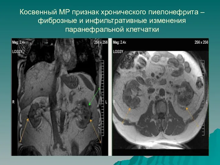 Косвенный МР признак хронического пиелонефрита – фиброзные и инфильтративные изменения паранефральной клетчатки