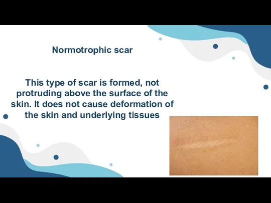 Normotrophic scar This type of scar is formed, not protruding above the