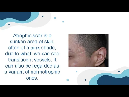 Atrophic scar is a sunken area of ​​skin, often of a pink