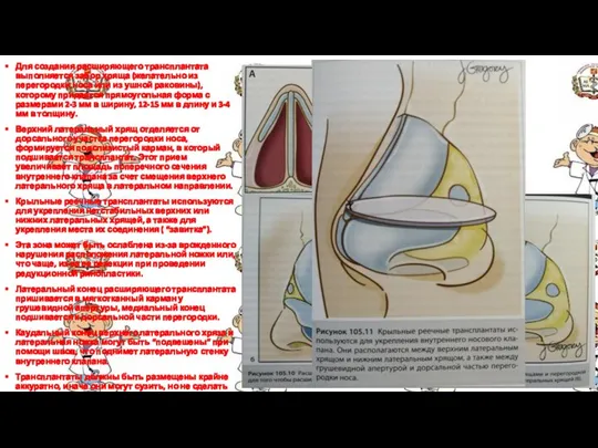 Для создания расширяющего трансплантата выполняется забор хряща (желательно из перегородки носа или