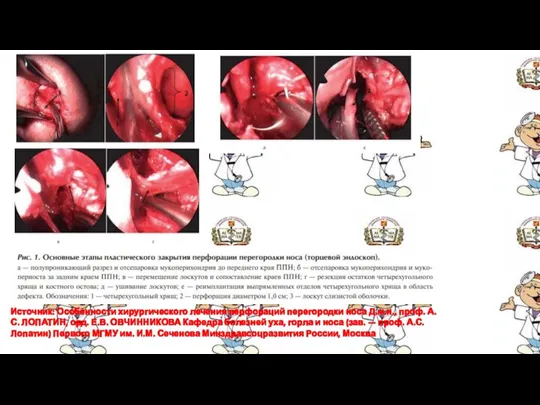 Источник: Особенности хирургического лечения перфораций перегородки носа Д.м.н., проф. А.С. ЛОПАТИН, орд.