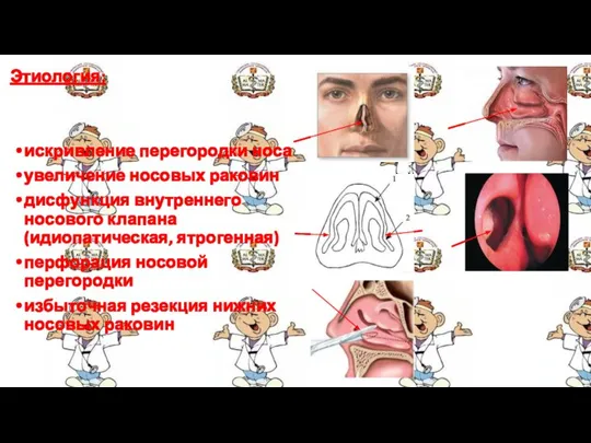 Этиология: искривление перегородки носа увеличение носовых раковин дисфункция внутреннего носового клапана (идиопатическая,