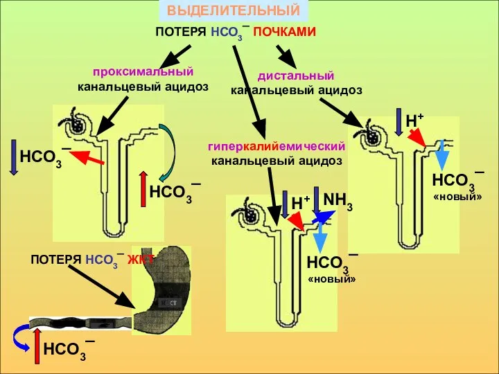 ВЫДЕЛИТЕЛЬНЫЙ проксимальный канальцевый ацидоз дистальный канальцевый ацидоз ПОТЕРЯ НСО3¯ ПОЧКАМИ гиперкалийемический канальцевый