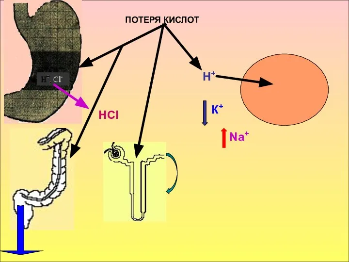 ПОТЕРЯ КИСЛОТ НСl Н+ К+ Na+