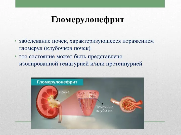 Гломерулонефрит заболевание почек, характеризующееся поражением гломерул (клубочков почек) это состояние может быть