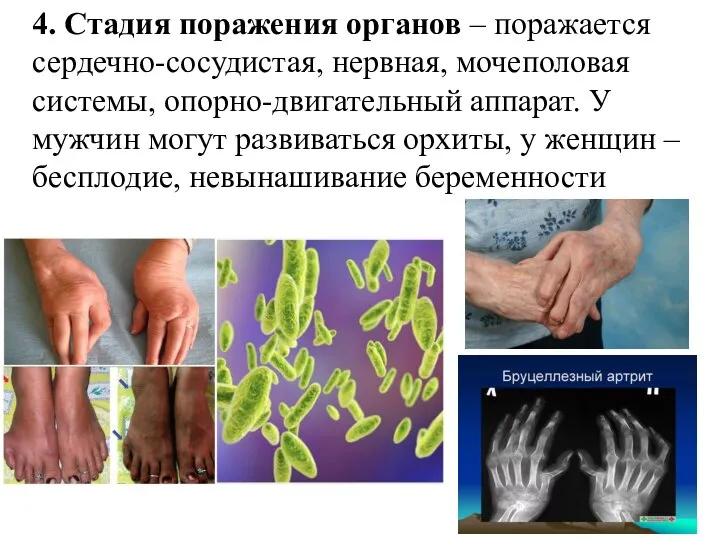 4. Стадия поражения органов – поражается сердечно-сосудистая, нервная, мочеполовая системы, опорно-двигательный аппарат.