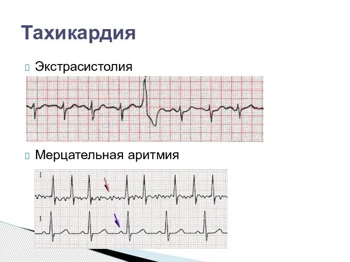 Экстрасистолия Мерцательная аритмия Тахикардия