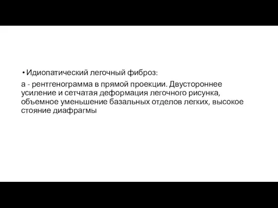 Идиопатический легочный фиброз: а - рентгенограмма в прямой проекции. Двустороннее усиление и