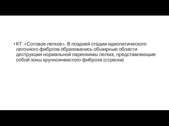 КТ. «Сотовое легкое». В поздней стадии идиопатического легочного фиброза образовались обширные области