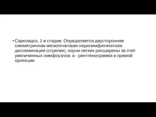 Саркоидоз, 2-я стадия. Определяется двусторонняя симметричная мелкоочаговая перилимфатическая диссеминация (стрелки), корни легких