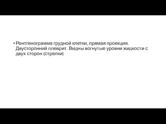 Рентгенограмма грудной клетки, прямая проекция. Двусторонний плеврит. Видны вогнутые уровни жидкости с двух сторон (стрелки)