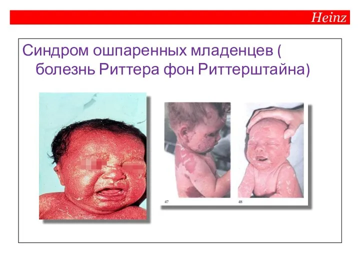Синдром ошпаренных младенцев ( болезнь Риттера фон Риттерштайна) Heinz