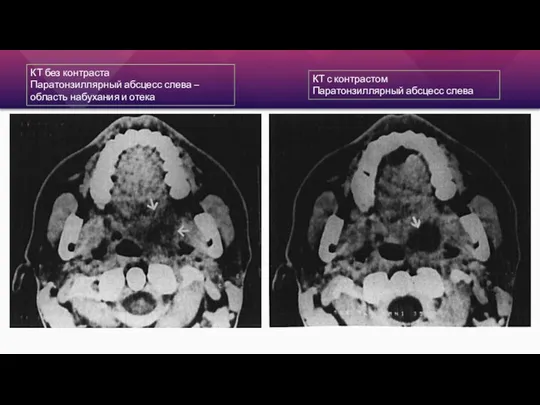 КТ без контраста Паратонзиллярный абсцесс слева – область набухания и отека КТ