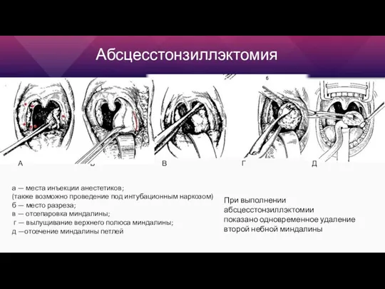 При выполнении абсцесстонзиллэктомии показано одновременное удаление второй небной миндалины а — места