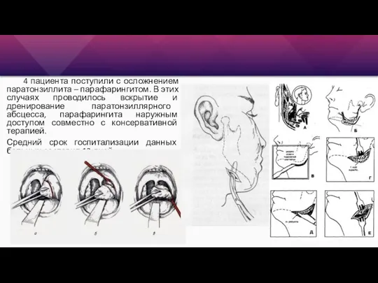 4 пациента поступили с осложнением паратонзиллита – парафарингитом. В этих случаях проводилось