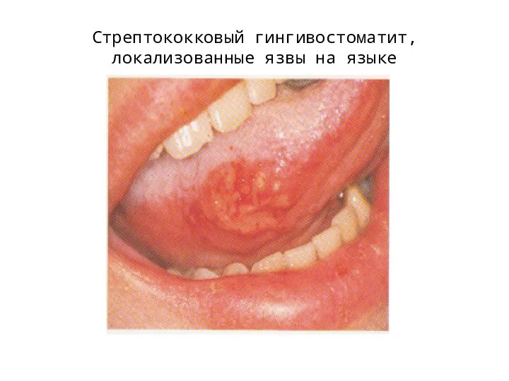 Стрептококковый гингивостоматит, локализованные язвы на языке