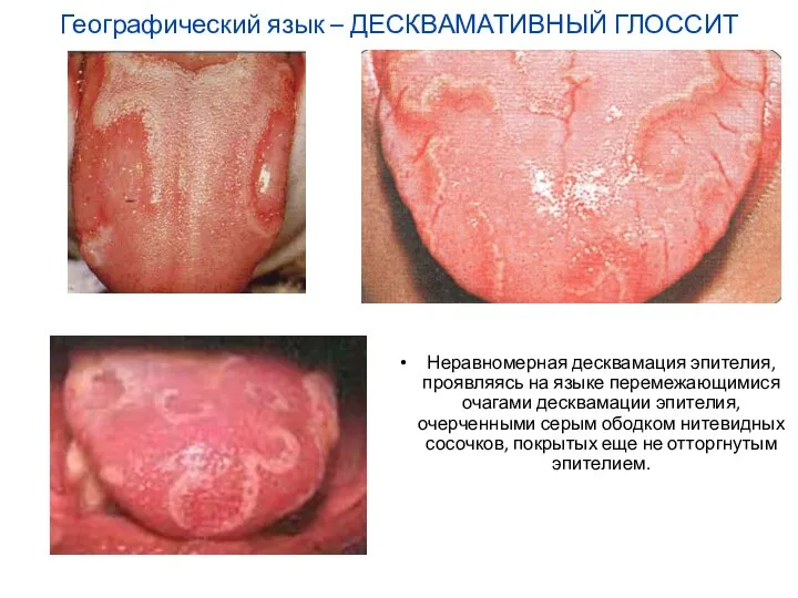 Географический язык – ДЕСКВАМАТИВНЫЙ ГЛОССИТ Неравномерная десквамация эпителия, проявляясь на языке перемежающимися