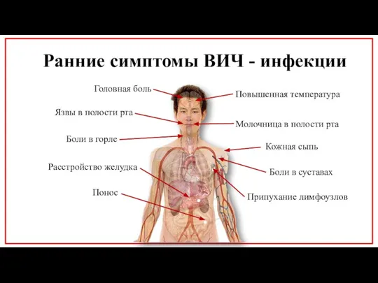 Ранние симптомы ВИЧ - инфекции Головная боль Повышенная температура Язвы в полости