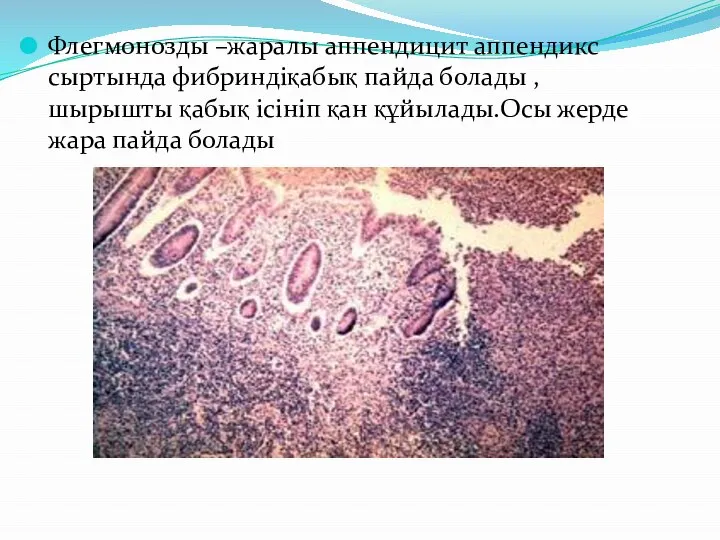 Флегмонозды –жаралы аппендицит аппендикс сыртында фибриндіқабық пайда болады ,шырышты қабық ісініп қан