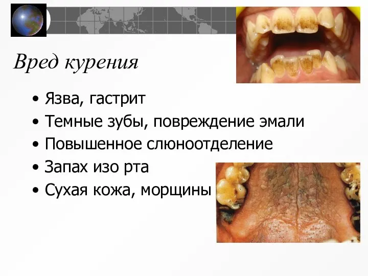 Вред курения Язва, гастрит Темные зубы, повреждение эмали Повышенное слюноотделение Запах изо рта Сухая кожа, морщины
