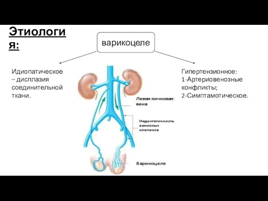 Этиология: варикоцеле Идиопатическое – дисплазия соединительной ткани. Гипертензионное: 1-Артериовенозные конфликты; 2-Симптамотическое.