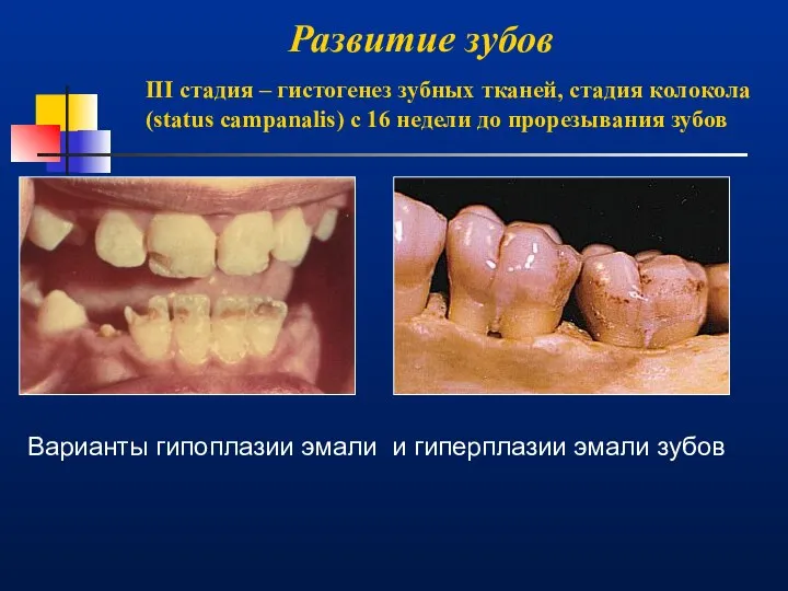 Развитие зубов III стадия – гистогенез зубных тканей, стадия колокола (status campanalis)