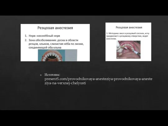 Источник: present5.com/provodnikovaya-anesteziya-provodnikovaya-anesteziya-na-verxnej-chelyusti