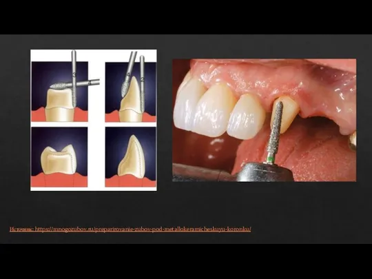 Источник: https://mnogozubov.ru/preparirovanie-zubov-pod-metallokeramicheskuyu-koronku/