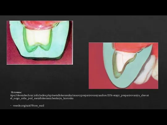 Источник: ttps://dentaltechnic.info/index.php/metallokeramika/osnovypreparirovaniyazubov/1376-etapy_preparirovaniya_zhevatel_nogo_zuba_pod_metallokeramicheskuyu_koronku - vmede.org/sait/?from_mail