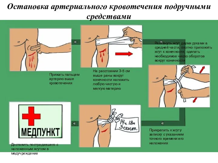 Остановка артериального кровотечения подручными средствами Прижать пальцем артерию выше кровотечения На расстоянии