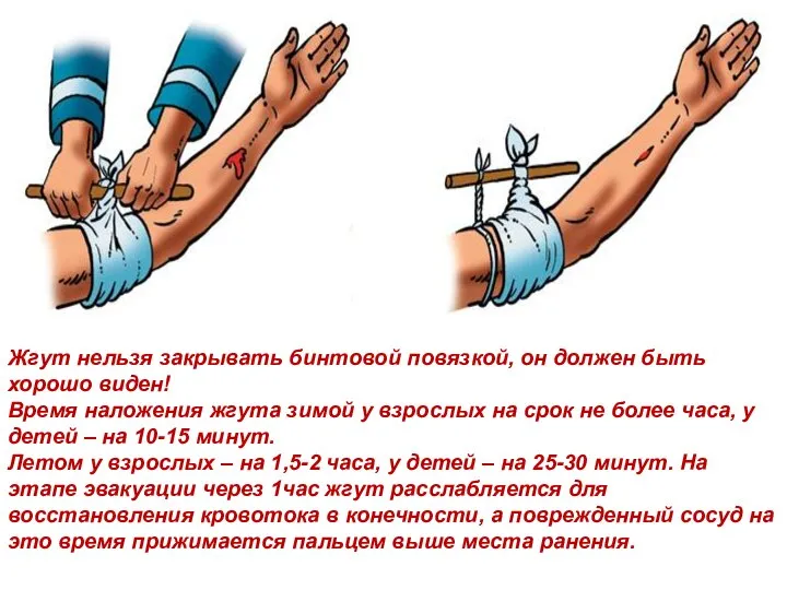 Жгут нельзя закрывать бинтовой повязкой, он должен быть хорошо виден! Время наложения