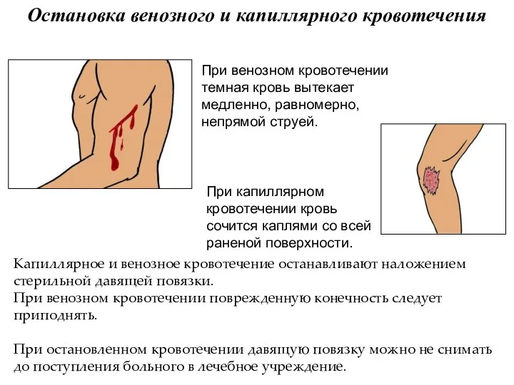 Остановка венозного и капиллярного кровотечения Капиллярное и венозное кровотечение останавливают наложением стерильной