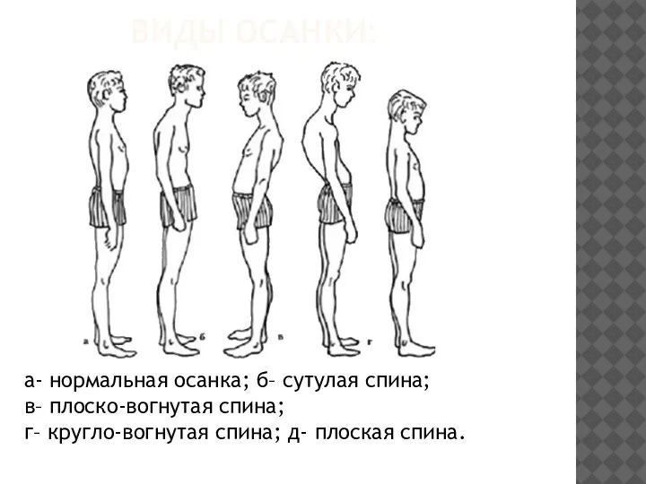 ВИДЫ ОСАНКИ: а- нормальная осанка; б– сутулая спина; в– плоско-вогнутая спина; г–