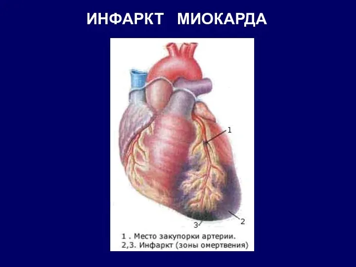 ИНФАРКТ МИОКАРДА