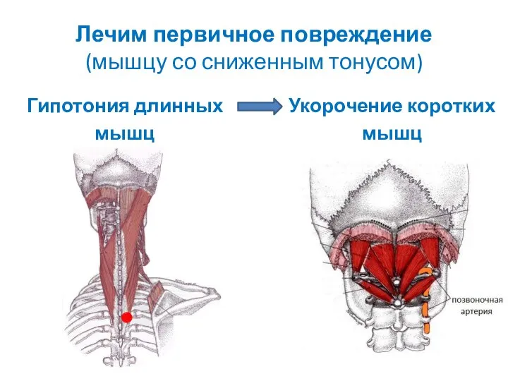 Лечим первичное повреждение (мышцу со сниженным тонусом) Гипотония длинных мышц Укорочение коротких мышц