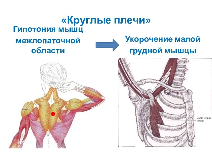 «Круглые плечи» Гипотония мышц межлопаточной области Укорочение малой грудной мышцы