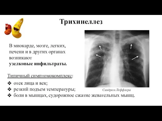 Трихинеллез В миокарде, мозге, легких, печени и в других органах возникают отек