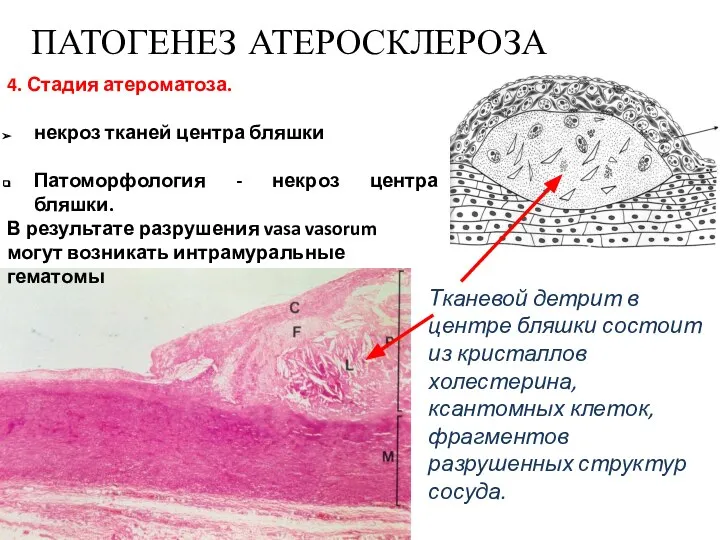 4. Стадия атероматоза. некроз тканей центра бляшки Патоморфология - некроз центра бляшки.