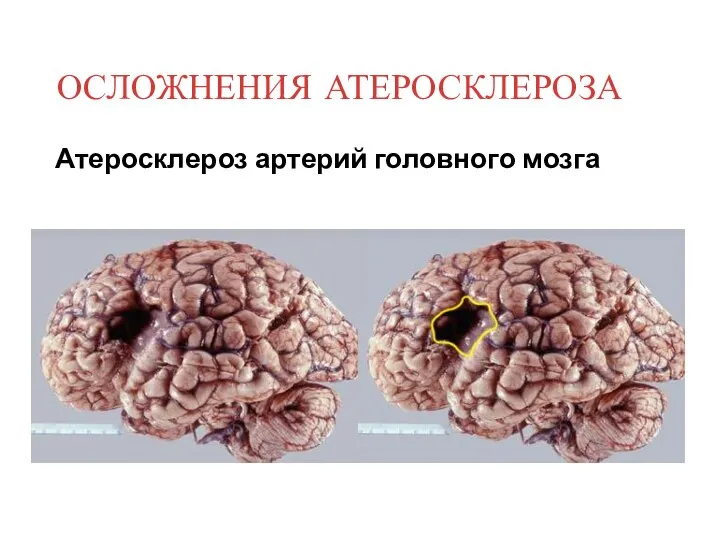 Атеросклероз артерий головного мозга ОСЛОЖНЕНИЯ АТЕРОСКЛЕРОЗА