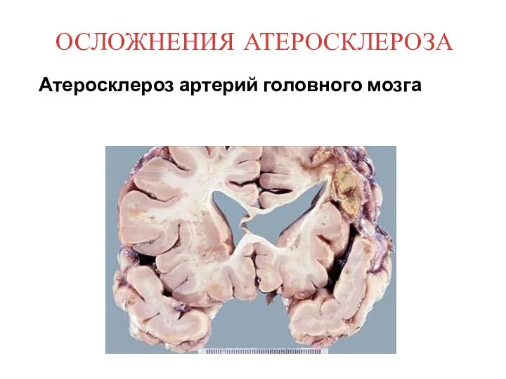 Атеросклероз артерий головного мозга ОСЛОЖНЕНИЯ АТЕРОСКЛЕРОЗА