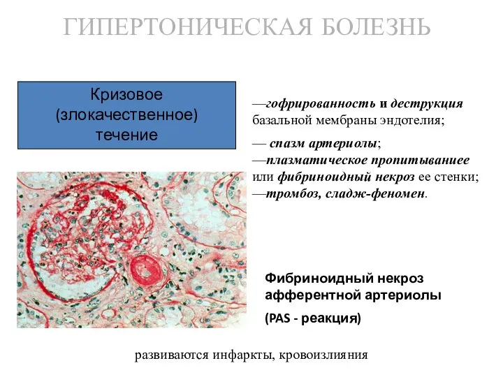 ГИПЕРТОНИЧЕСКАЯ БОЛЕЗНЬ Фибриноидный некроз афферентной артериолы (PAS - реакция) —гофрированность и деструкция