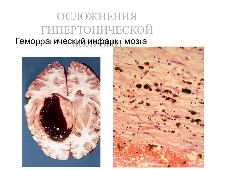 ОСЛОЖНЕНИЯ ГИПЕРТОНИЧЕСКОЙ БОЛЕЗНИ Геморрагический инфаркт мозга
