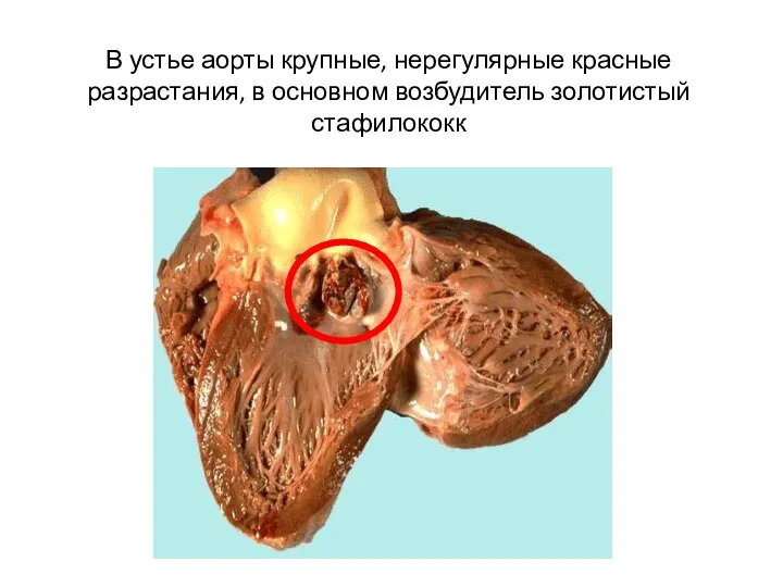 В устье аорты крупные, нерегулярные красные разрастания, в основном возбудитель золотистый стафилококк