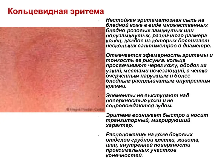 Кольцевидная эритема Нестойкая эритематозная сыпь на бледной коже в виде множественных бледно-розовых