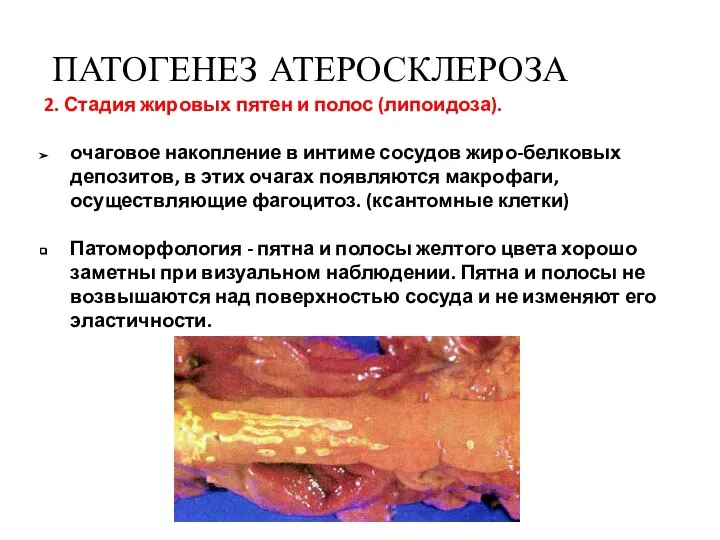 2. Стадия жировых пятен и полос (липоидоза). очаговое накопление в интиме сосудов