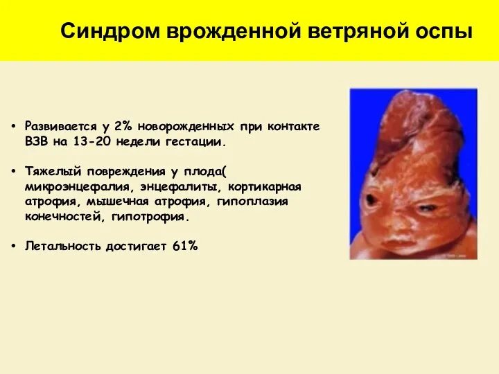 Синдром врожденной ветряной оспы Развивается у 2% новорожденных при контакте ВЗВ на